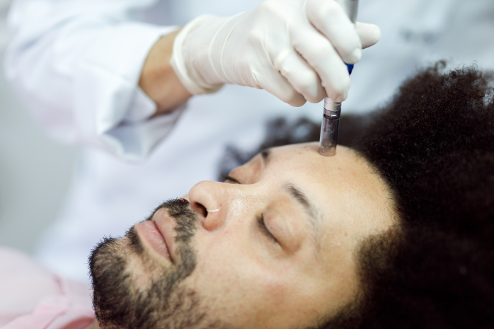 Nano Needling Treatment