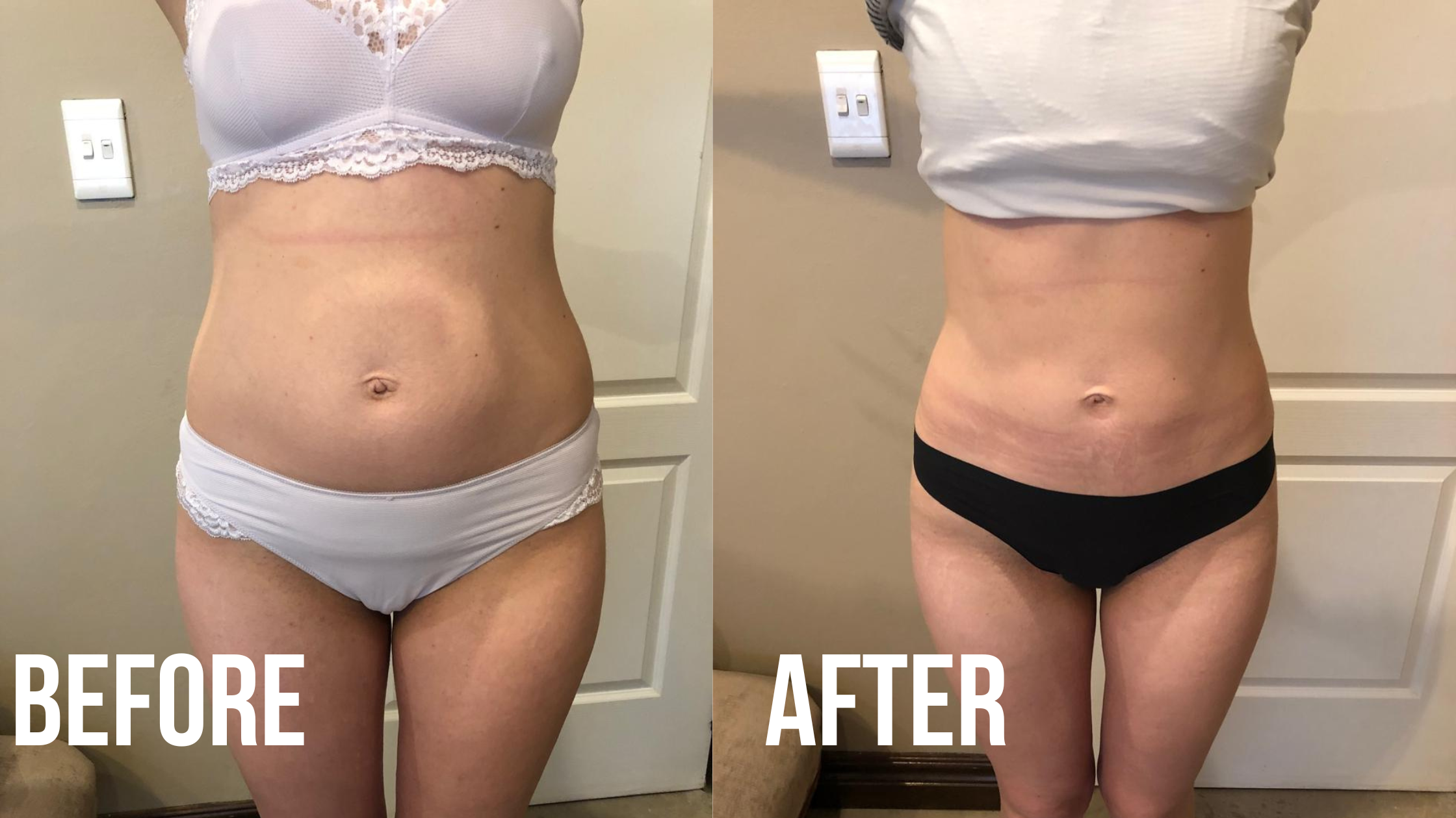 Fat freezing before and after results showing reduced abdominal fat.
