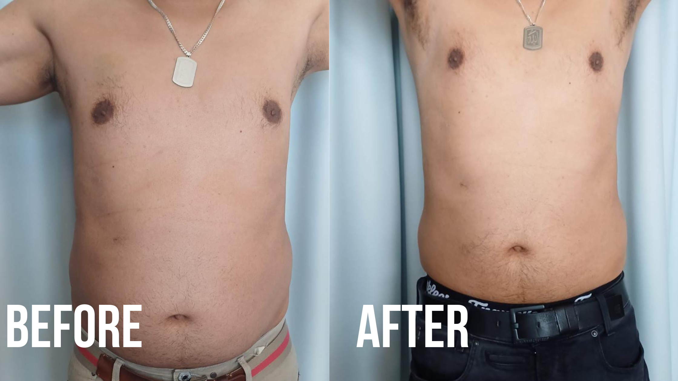 Fat freezing before and after showcasing noticeable reduction in abdominal fat in men.